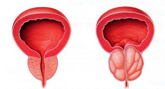 prostată sănătoasă și inflamată cu prostatită cronică