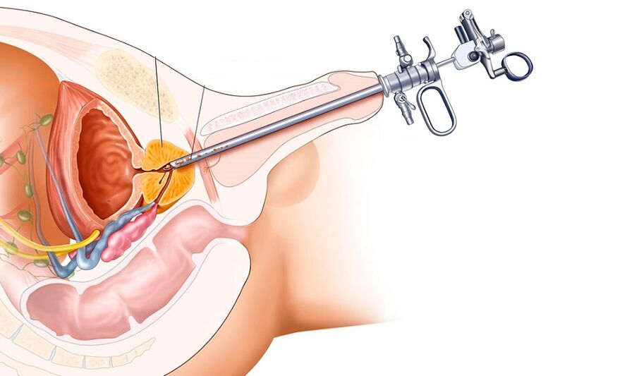 Tratamentul chirurgical al prostatitei